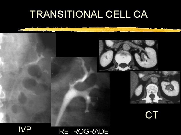 TRANSITIONAL CELL CA CT IVP RETROGRADE 