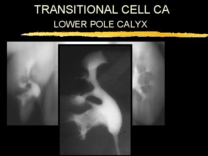 TRANSITIONAL CELL CA LOWER POLE CALYX 