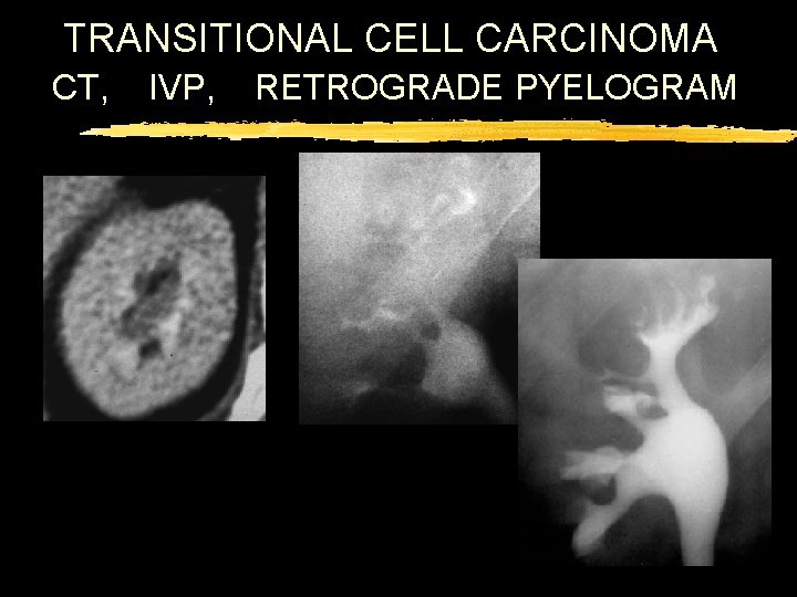 TRANSITIONAL CELL CARCINOMA CT, IVP, RETROGRADE PYELOGRAM 