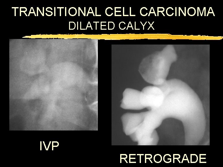 TRANSITIONAL CELL CARCINOMA DILATED CALYX IVP RETROGRADE 