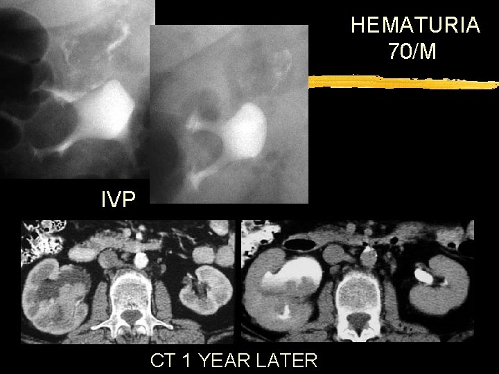 HEMATURIA 70/M IVP CT 1 YEAR LATER 