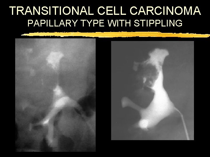 TRANSITIONAL CELL CARCINOMA PAPILLARY TYPE WITH STIPPLING 