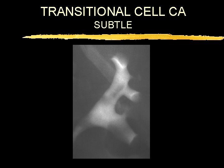 TRANSITIONAL CELL CA SUBTLE 