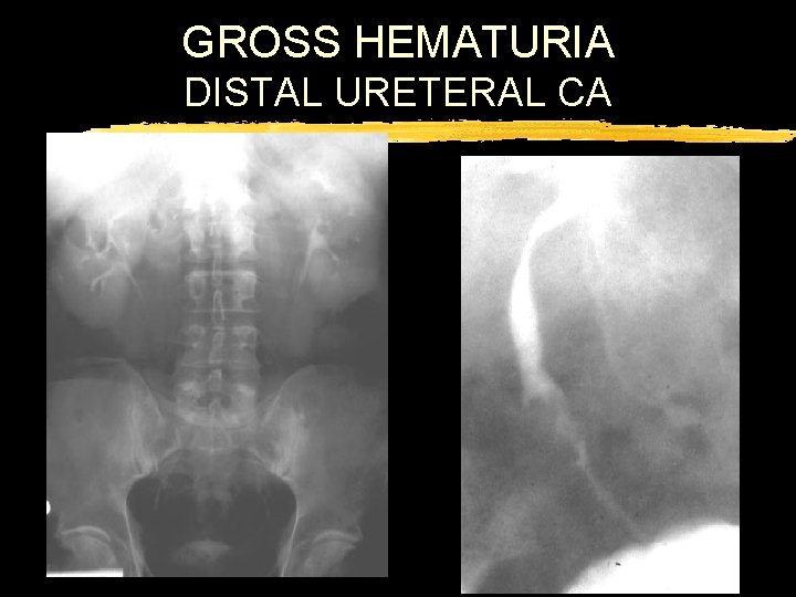 GROSS HEMATURIA DISTAL URETERAL CA 