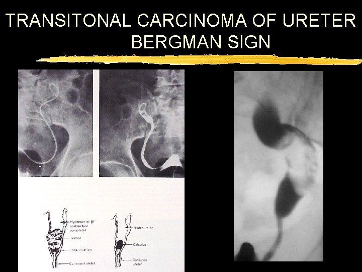 TRANSITONAL CARCINOMA OF URETER BERGMAN SIGN 