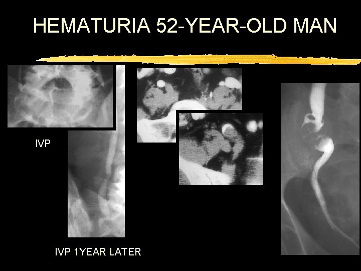 HEMATURIA 52 -YEAR-OLD MAN IVP 1 YEAR LATER 