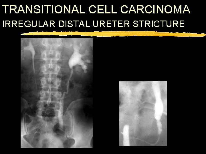 TRANSITIONAL CELL CARCINOMA IRREGULAR DISTAL URETER STRICTURE 