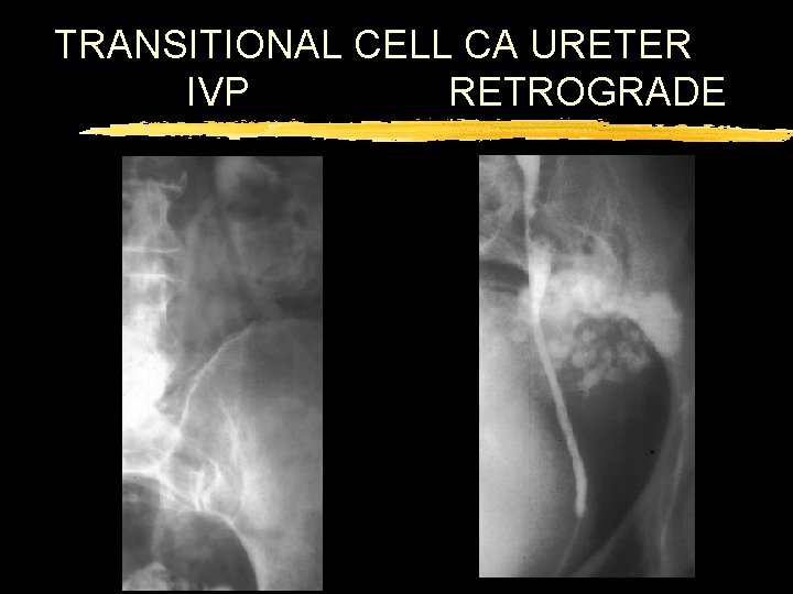 TRANSITIONAL CELL CA URETER IVP RETROGRADE 