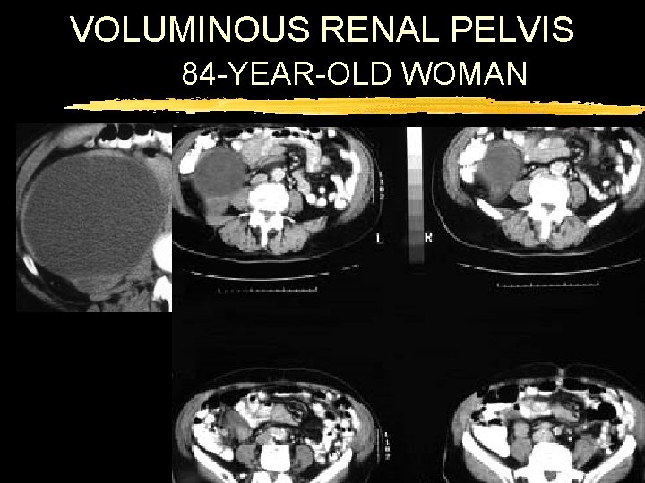 VOLUMINOUS RENAL PELVIS 84 -YEAR-OLD WOMAN 