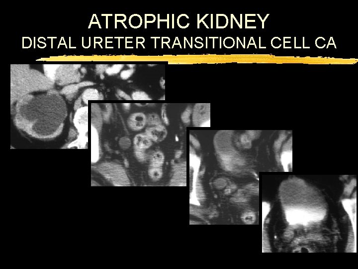 ATROPHIC KIDNEY DISTAL URETER TRANSITIONAL CELL CA 