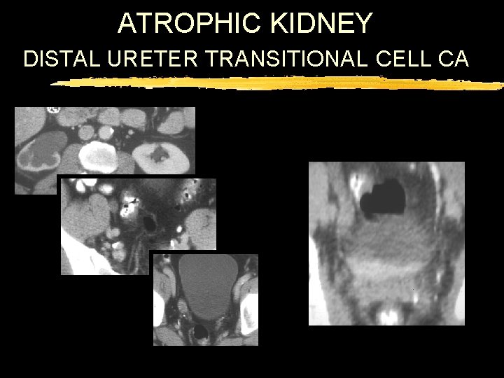 ATROPHIC KIDNEY DISTAL URETER TRANSITIONAL CELL CA 