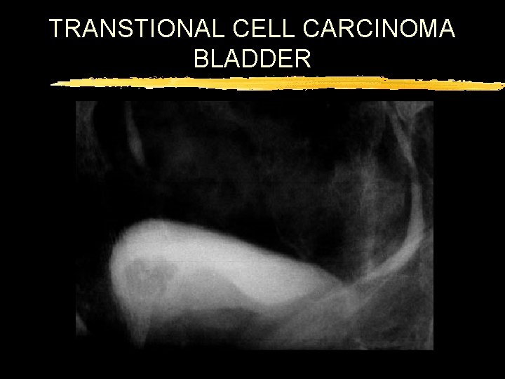 TRANSTIONAL CELL CARCINOMA BLADDER 