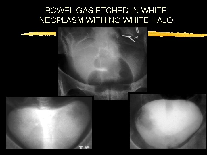 BOWEL GAS ETCHED IN WHITE NEOPLASM WITH NO WHITE HALO 