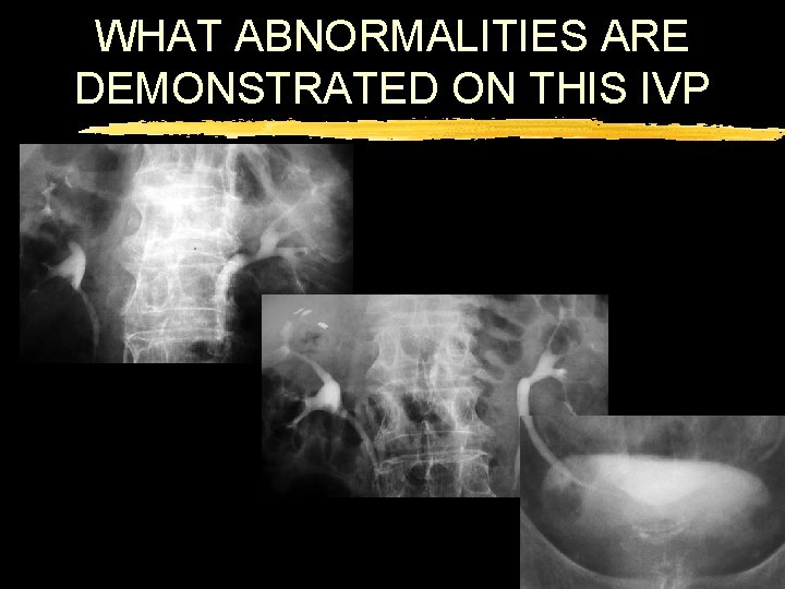 WHAT ABNORMALITIES ARE DEMONSTRATED ON THIS IVP 