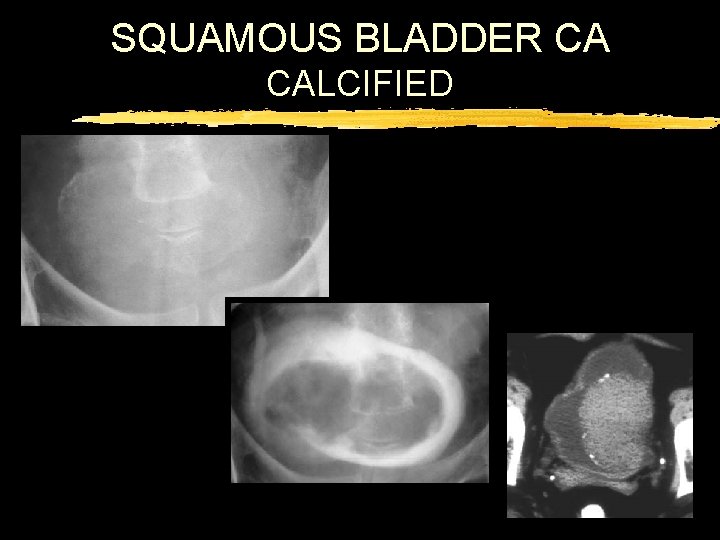 SQUAMOUS BLADDER CA CALCIFIED 