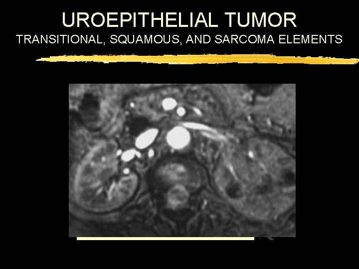 UROEPITHELIAL TUMOR TRANSITIONAL, SQUAMOUS, AND SARCOMA ELEMENTS 