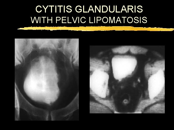 CYTITIS GLANDULARIS WITH PELVIC LIPOMATOSIS 