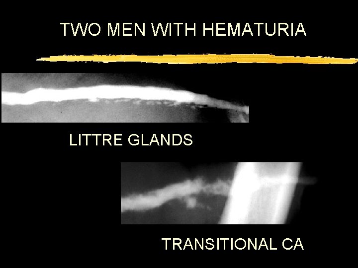 TWO MEN WITH HEMATURIA LITTRE GLANDS TRANSITIONAL CA 