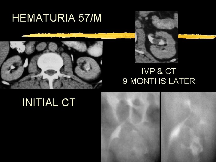 HEMATURIA 57/M IVP & CT 9 MONTHS LATER INITIAL CT 