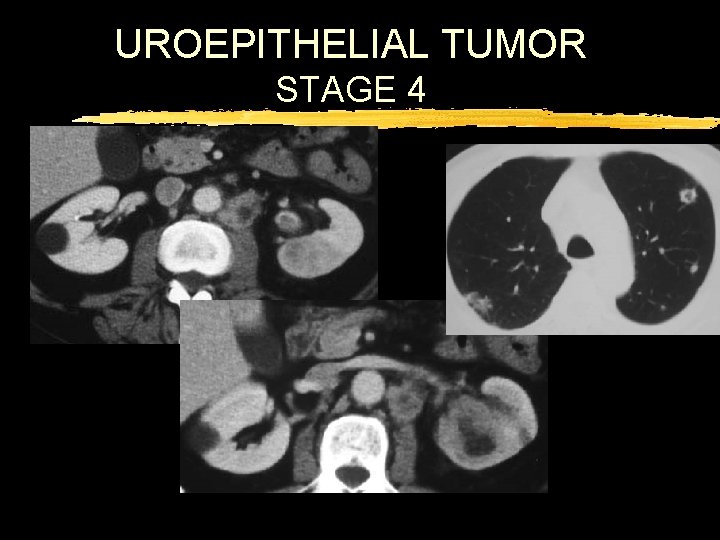 UROEPITHELIAL TUMOR STAGE 4 