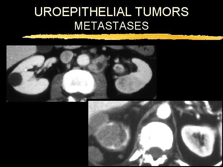 UROEPITHELIAL TUMORS METASTASES 