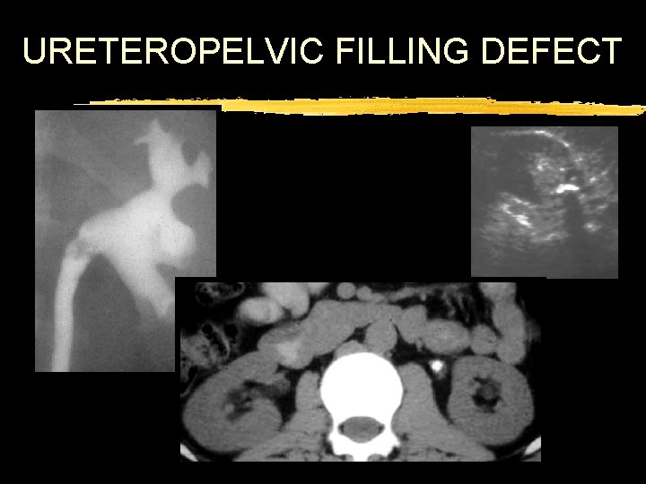 URETEROPELVIC FILLING DEFECT 