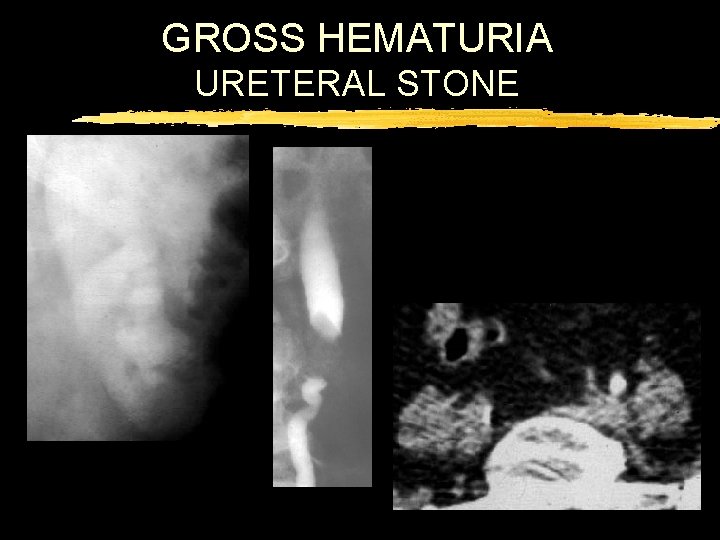 GROSS HEMATURIA URETERAL STONE 