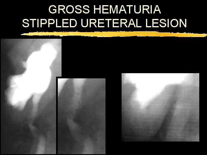 GROSS HEMATURIA STIPPLED URETERAL LESION 