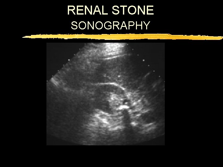 RENAL STONE SONOGRAPHY 