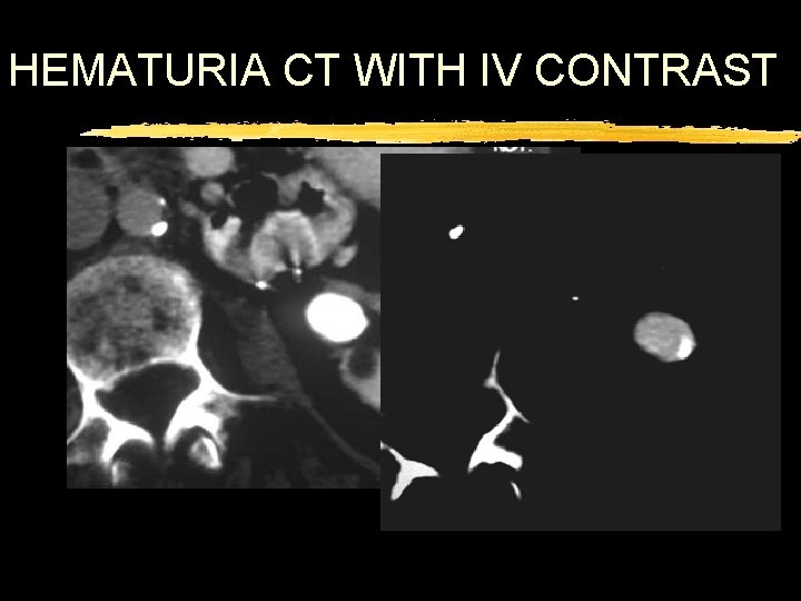 HEMATURIA CT WITH IV CONTRAST 