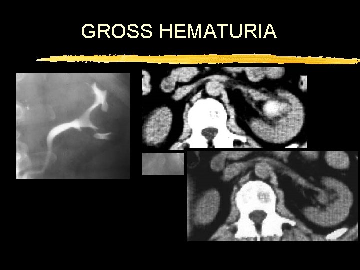 GROSS HEMATURIA 