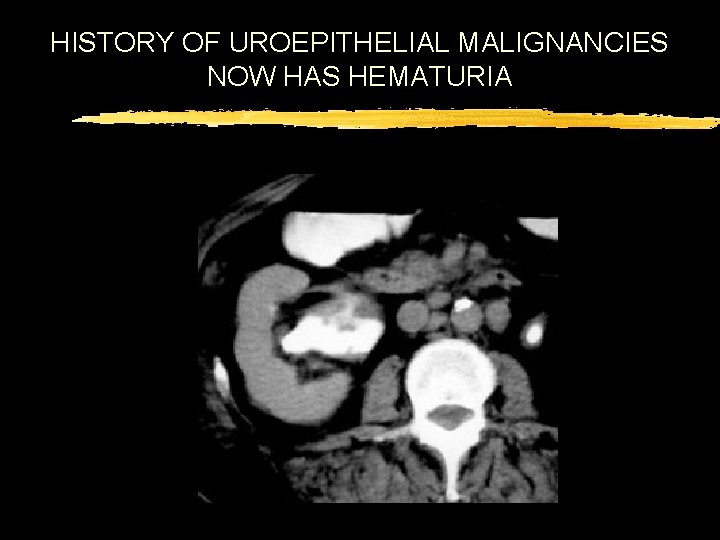 HISTORY OF UROEPITHELIAL MALIGNANCIES NOW HAS HEMATURIA 