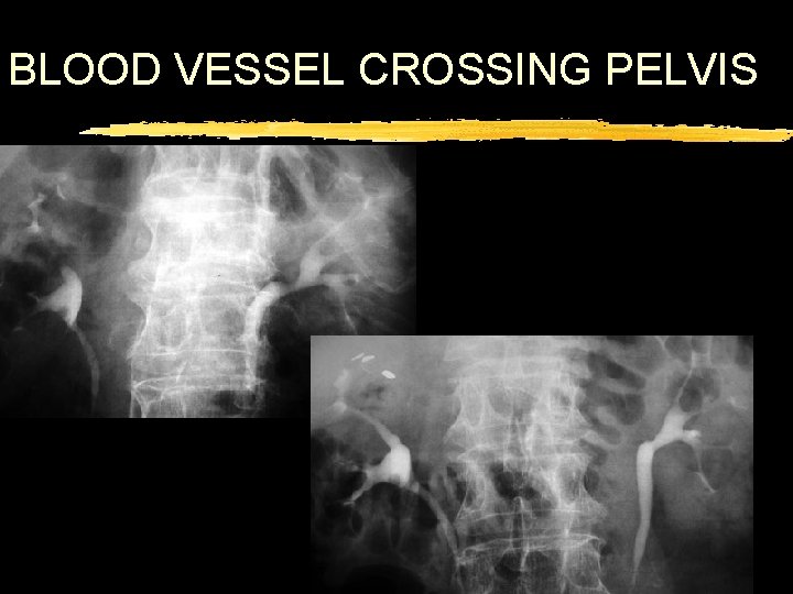 BLOOD VESSEL CROSSING PELVIS 