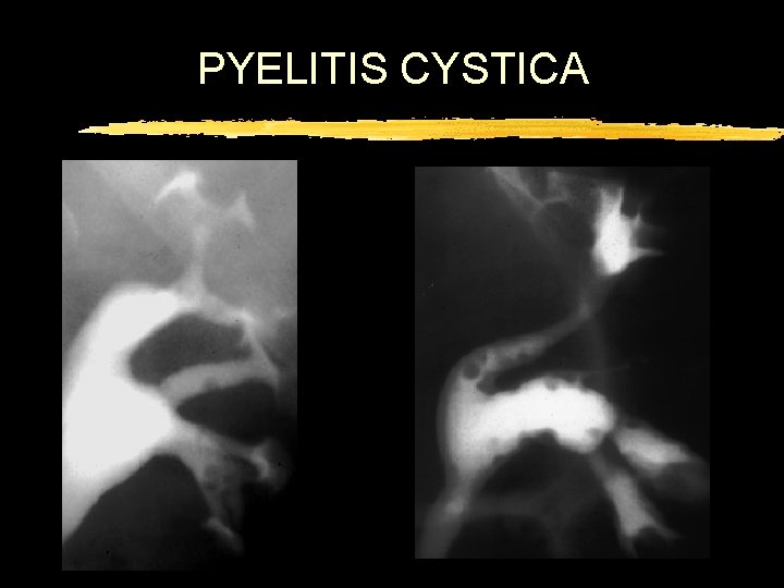 PYELITIS CYSTICA 