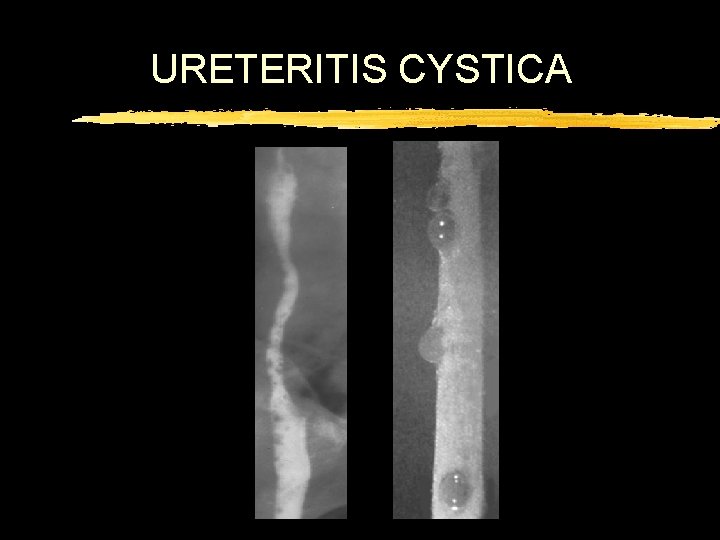 URETERITIS CYSTICA 