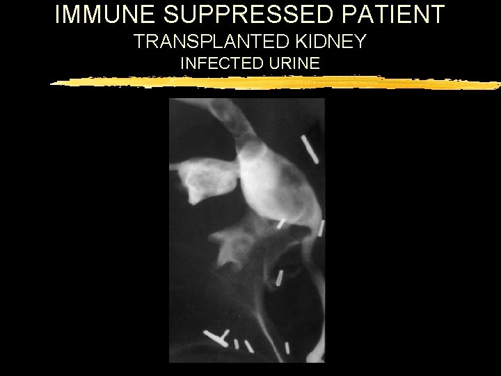 IMMUNE SUPPRESSED PATIENT TRANSPLANTED KIDNEY INFECTED URINE 