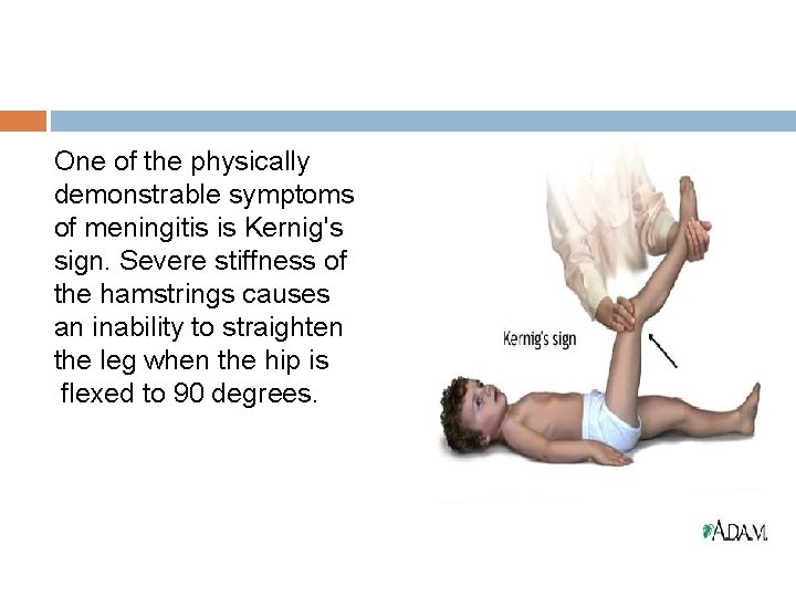 One of the physically demonstrable symptoms of meningitis is Kernig's sign. Severe stiffness of One of the physically demonstrable symptoms of meningitis is Kernig's sign. Severe stiffness of