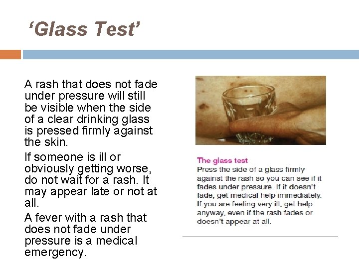 ‘Glass Test’ A rash that does not fade under pressure will still be visible ‘Glass Test’ A rash that does not fade under pressure will still be visible