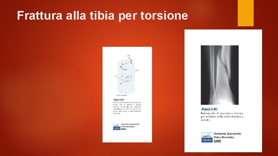 Frattura alla tibia per torsione 