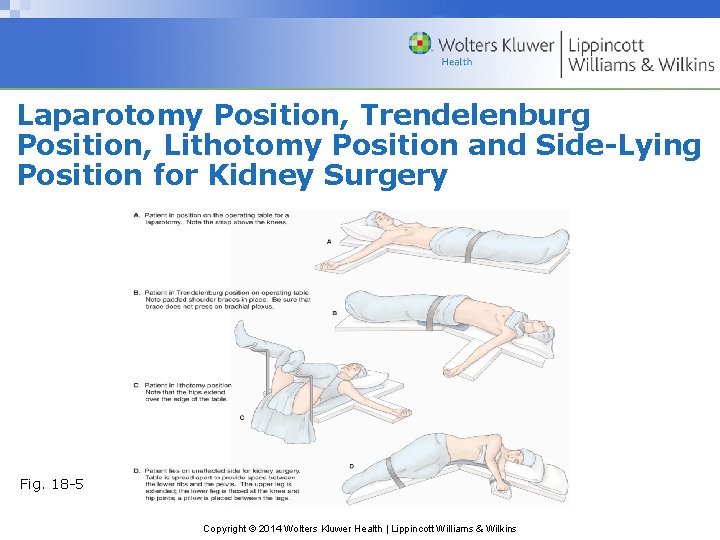 Laparotomy Position, Trendelenburg Position, Lithotomy Position and Side-Lying Position for Kidney Surgery Fig. 18 Laparotomy Position, Trendelenburg Position, Lithotomy Position and Side-Lying Position for Kidney Surgery Fig. 18