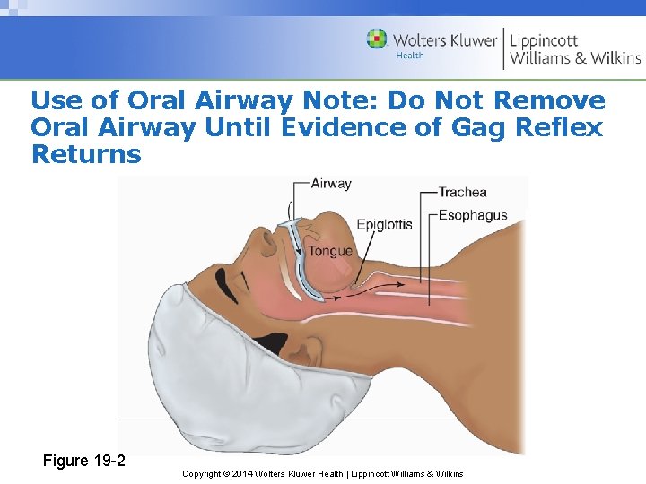 Use of Oral Airway Note: Do Not Remove Oral Airway Until Evidence of Gag Use of Oral Airway Note: Do Not Remove Oral Airway Until Evidence of Gag