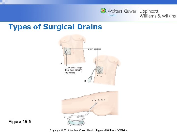 Types of Surgical Drains Figure 19 -5 Copyright © 2014 Wolters Kluwer Health | Types of Surgical Drains Figure 19 -5 Copyright © 2014 Wolters Kluwer Health |
