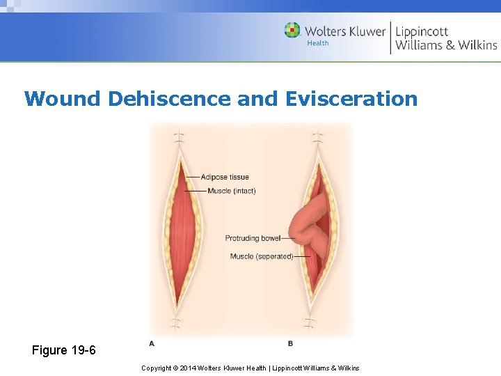 Wound Dehiscence and Evisceration Figure 19 -6 Copyright © 2014 Wolters Kluwer Health | Wound Dehiscence and Evisceration Figure 19 -6 Copyright © 2014 Wolters Kluwer Health |