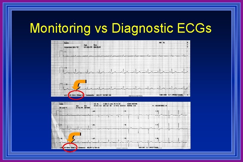 Monitoring vs Diagnostic ECGs 