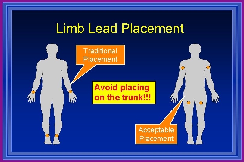 Limb Lead Placement Traditional Placement Avoid placing on the trunk!!! Acceptable Placement 