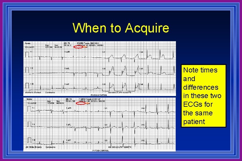 When to Acquire Note times and differences in these two ECGs for the same