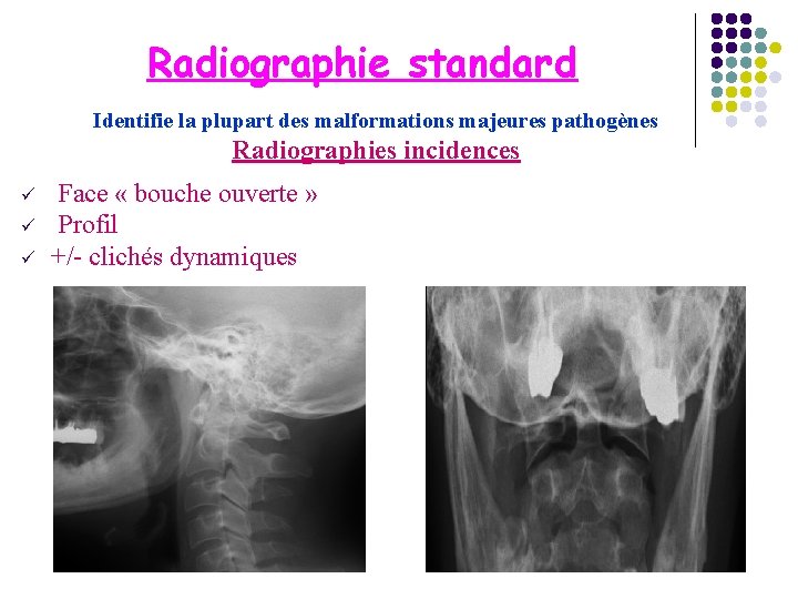 Radiographie standard Identifie la plupart des malformations majeures pathogènes Radiographies incidences ü ü ü