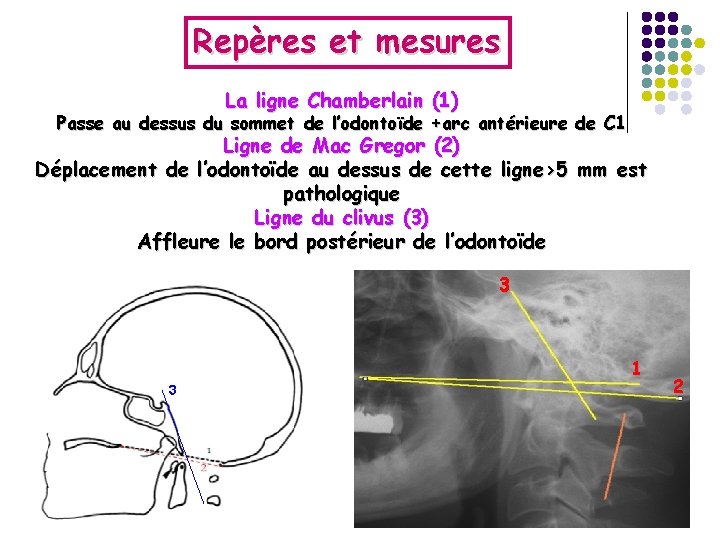 Repères et mesures La ligne Chamberlain (1) Passe au dessus du sommet de l’odontoïde