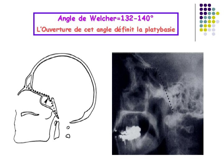 Angle de Welcher=132 -140° L’Ouverture de cet angle définit la platybasie 