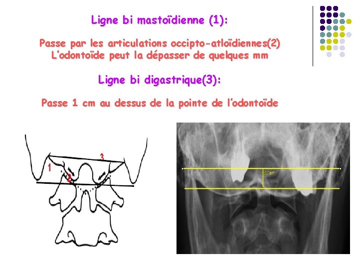 Ligne bi mastoïdienne (1): Passe par les articulations occipto-atloïdiennes(2) L’odontoïde peut la dépasser de